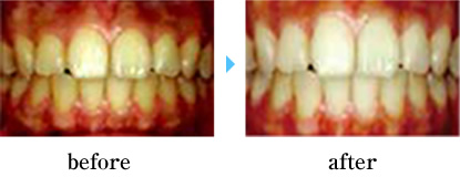 セルフホワイトニング