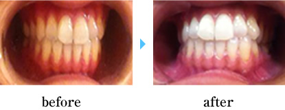 セルフホワイトニング