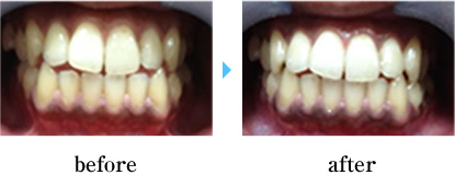 セルフホワイトニング